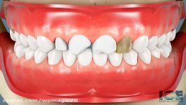 Dental Veneers  How They Are Put On