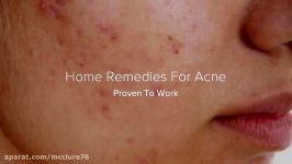 Home Remedies For Acne Proven to work