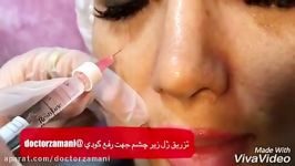 رفع گودی زیر چشم تزریق فیلر