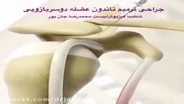 جراحی عضله دوسربازو. مشاوره پزشکی فیزیوتراپی09122655648