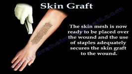 SKIN GRAFT  PART 1 . EVERYTHING YOU NEED TO KNOW  DR. NABI