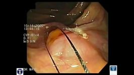 Colon  Polypectomy Saline lift Adenomas Surgeries