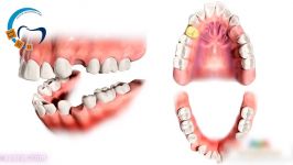 کشیدن دندان در ارتودنسی  دکتر مسعود داودیان