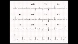 EKG