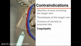 فشار ورید مرکزی CVP ؛ ویدیو نحوه جایگذاری کاتتر