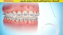 روش صحیح استفاده نخ دندان برای دندانهای ارتودنسی شده