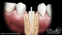 پست کور دندان  دندانستان