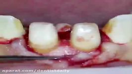 Dental crown lengthening