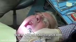 Dental Implant  including extraction  NobelActive