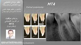 رمزهای موفقیت در کاربرد کلینیکی MTA بخش 2دکتر شنتیایی