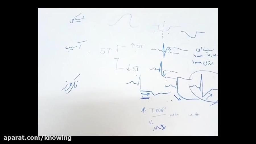 تغییرات ECG در MI