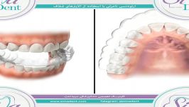 ارتودنسی نامرئی الاینرهای شفاف  دندانپزشکی سیمادنت