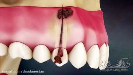 انیمیشن دندانپزشکی پوسیدگی دندان  دندانستان