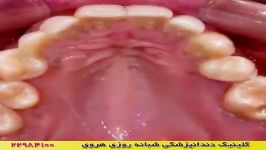 مرتب شدن دندان های ارتودنسی لینگوال