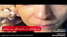 رفع گودی زیر چشم تزریق فیلر