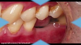 Abutment level impression in implant dentistry