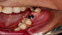 Using perforated frame in implant dentistry