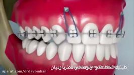 مینی اسکرو در درمان لبخند لثه ای  دکتر مسعود داوودیان