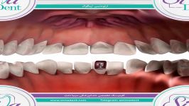 ارتودنسی لینگوال  دندانپزشکی سیمادنت