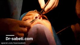 عمل جراحی بینی ترمیمی دکتر کسری ثابتی