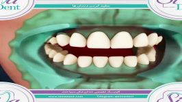 بلیچینگ  سفیدکردن دندان  دندانپزشکی سیمادنت