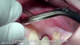 Maxillary premolar Cystic lesion using INNO and CowellB