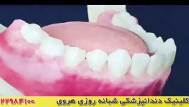 سلامت دندان ها جرم گیری دندان