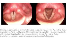 vocal cord dysfunction  Patient Education Video