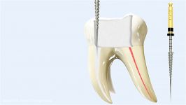 Endodontic Dental Files 3D Animation