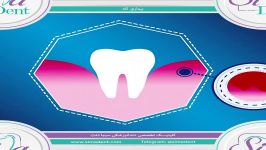 انیمیشن بیماری لثه  دندانپزشکی سیمادنت