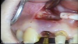 CWM Cowellmedi MiniPlus Surgery Video