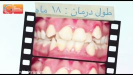 کشیدن دندان برای ارتودنسی  دکتر مسعود داوودیان