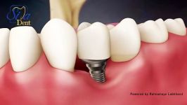 از دست دادن دندان تحلیل لثه  دندانپزشکی سیمادنت