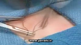 بخیه زنی داخل جلدی sub dermal