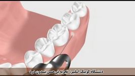 دستگاه كوییك اسلیپر تجربه بی حسی بدون درد