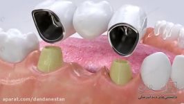بریج دندان  دندانستان