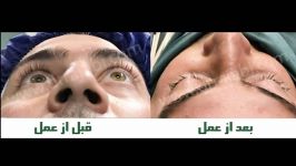 اصلاح گودافتادکی چشم کارگذاری پروتز چشمی