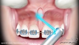 جراحی فرنوم  دندانستان