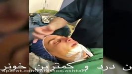 نمونه عمل بینی گوشتی به روش بسته توسط دکتر ارسطو اشتری