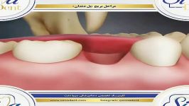 بریج دندان  دندانپزشکی سیمادنت