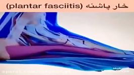 خار پاشنه Plantar fasciitis. مشاوره پزشکی فیزیوتراپی09122655648