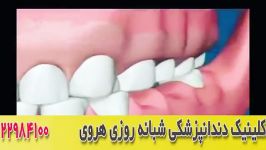 مقایسه ایمپلنت دندان بریج دندان