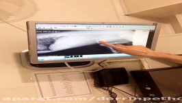 جراحی شکستگی دیستال فمور دامپزشکی درین