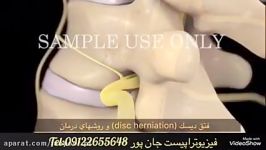 فتق دیسک disc herniation. درمان فیزیوتراپی09122655648