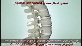 تنگی كانال نخاعspinal stenosis. فیزیوتراپی09122655648