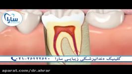 عصب کشی استفاده ازفایل