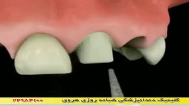 نحوه بریج دندان ایمپلنت دندان