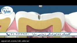 مقایسه آمالگام کامپوزیت