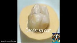 instruments for class II amalgam restoration dentist sa