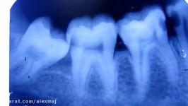 Class 2 cavity preparation for amalgam demonstration